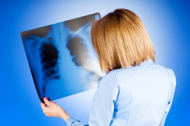 טיפול חדשני עשוי לדחות את הצורך בהשתלות ריאה בקרב הסובלים מ-COPD